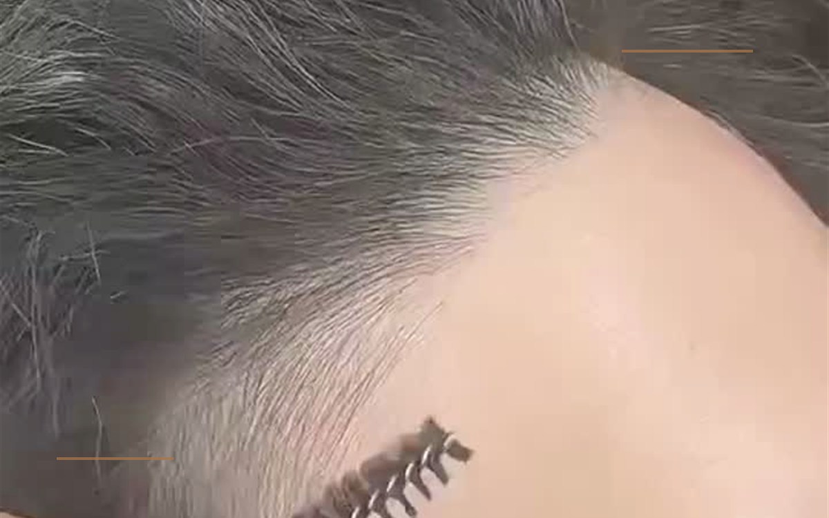 Temple hairline cover